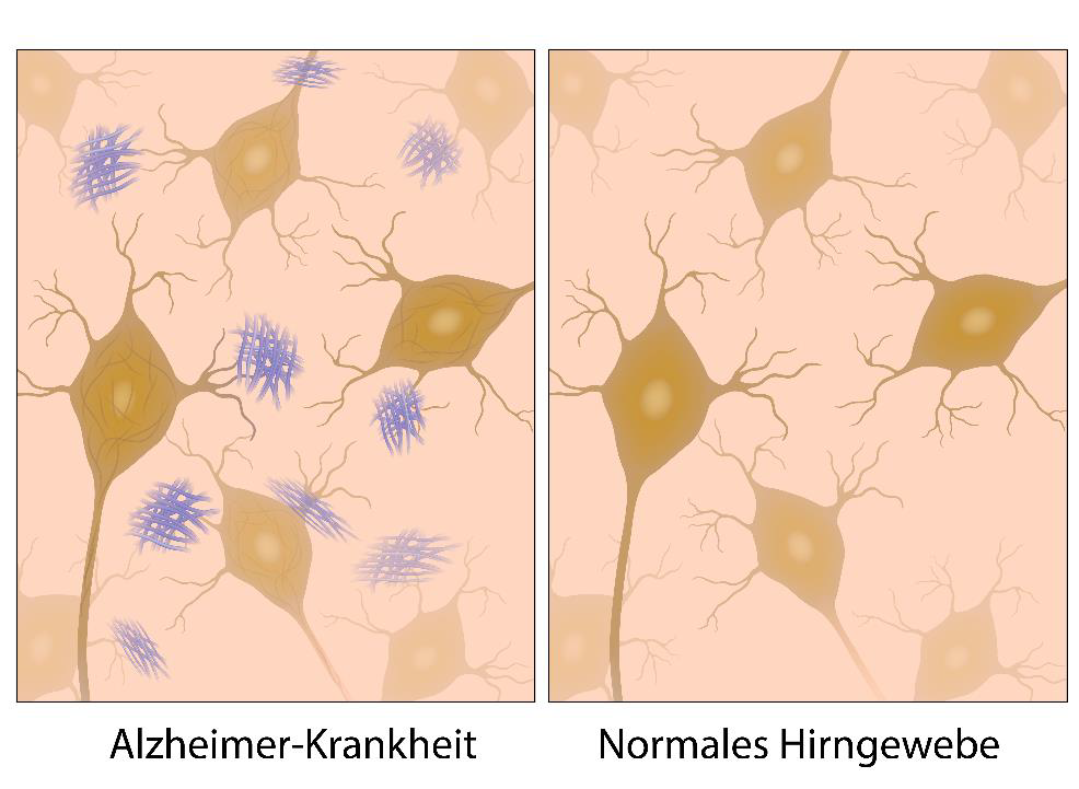 Darstellung von Hirngewebe bei Alzheimer-Krankheit mit typischen Beta-Amyloid-Ablagerungen und normalem Hirngewebe