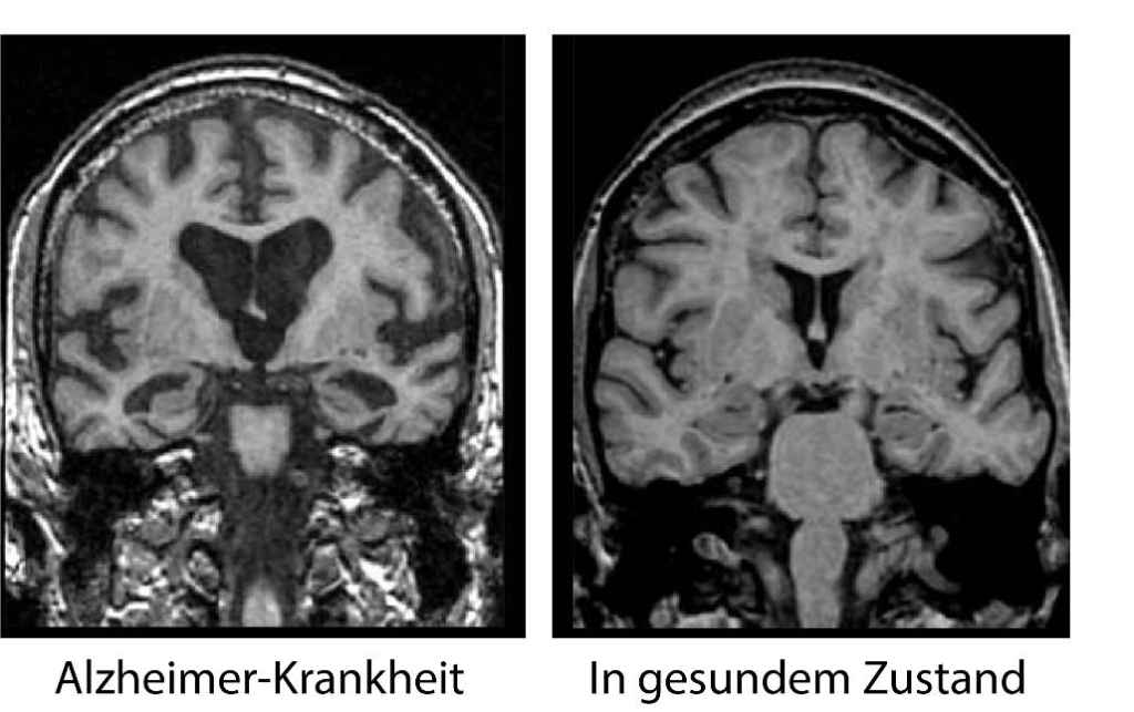 Kernspintomographische Darstellung (cMRT) des Gehirns bei Alzheimer-Krankheit mit typischem Rückgang von Hirnvolumen (Atrophie) und in gesundem Zustand.