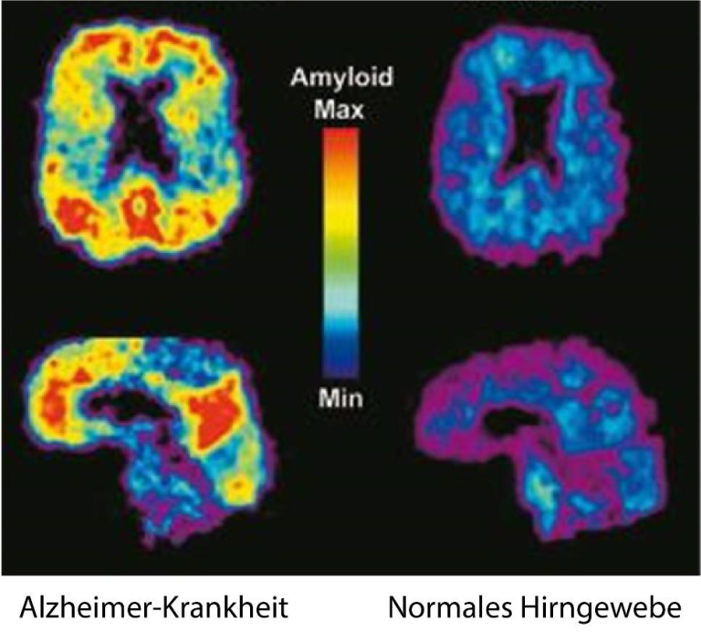 Nuklearmedizinische Darstellung von Hirngewebe bei Alzheimer-Krankheit mit typischen Beta-Amyloid-Ablagerungen und normalem Hirngewebe. Beta-Amyloid-Ablagerungen (gelb bis rot) werden sichtbar.